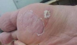 吃白瓜会加重脚气吗,揭秘食用白瓜对脚气的影响