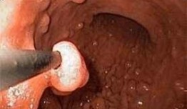 息肉切后可以吃凉瓜吗,凉瓜食用指南