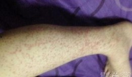 过敏性紫癜可以吃瓜吗,瓜类食物的适宜与禁忌