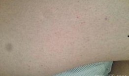 过敏性紫癜可以吃瓜吗,瓜类食物的适宜与禁忌