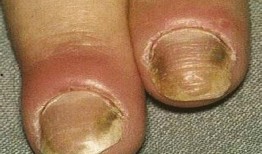 吃瓜甲沟炎,夏日饮食健康警示